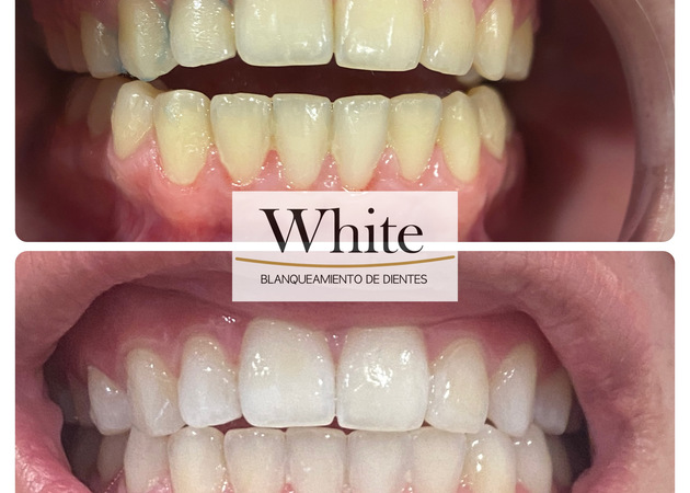 Image gallery White Teeth whitening Madrid 5