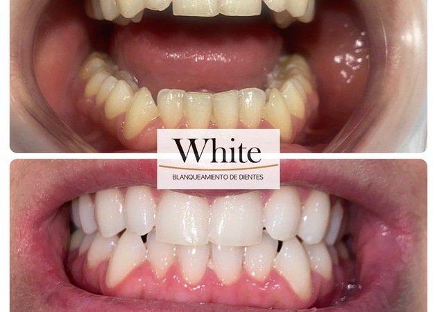 Image gallery White Teeth whitening Madrid 4